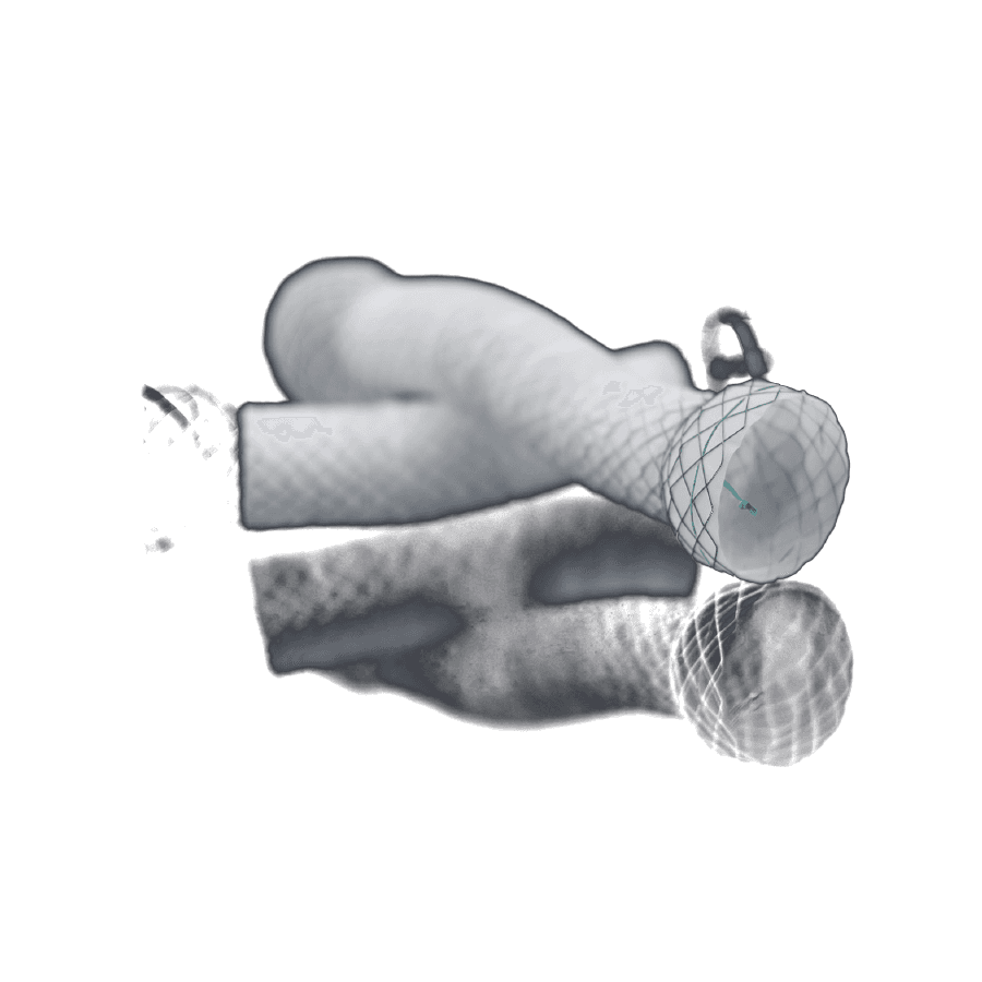 Biliyer Stent Kaplı — görsel 1